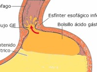 Papel del bolsillo ácido gástrico en el reflujo gastroesofágico postprandial.