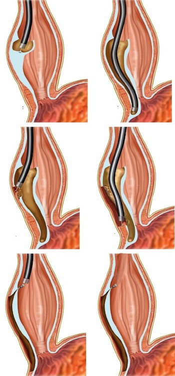 POEM (miotomia endoscópica per-oral)