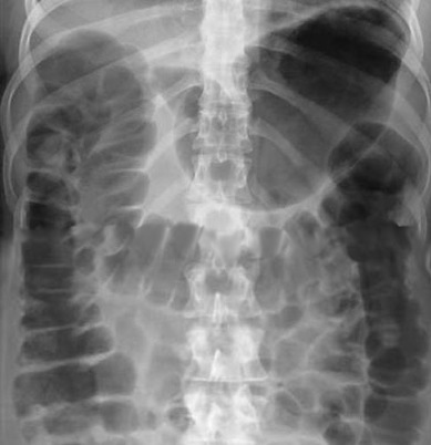 Aerofagia en radiografía simple de abdomen
